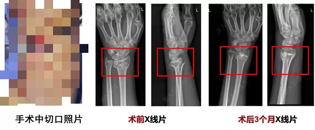 打一针就能治疗粉碎性骨折,浙大团队研发出全球首款“骨胶水”