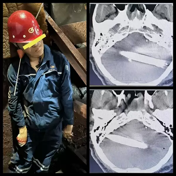 颅脑贯穿伤救治手术现场