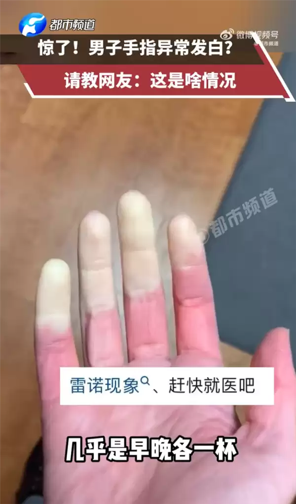 男子早晚一杯奶茶手指突变惨白 在线请教网友：这是啥情况