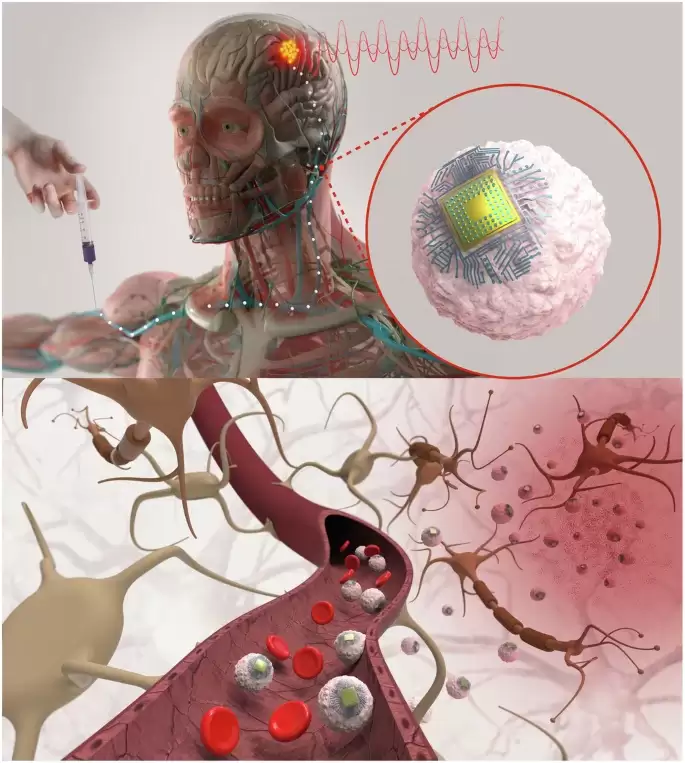 无线电子大脑植入新技术有望治疗多种神经疾病