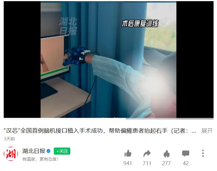 国产脑机接口芯片首例临床植入成功