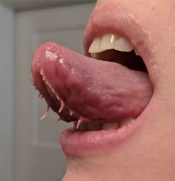 男子舌头天生异常:下面居然长着两条“流苏”!