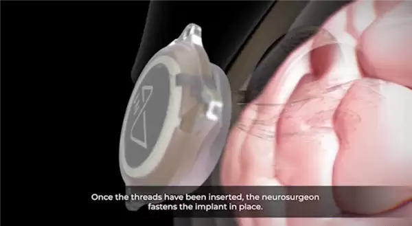 1.5秒植入!马斯克脑机接口公司技术新突破 超万人等待上脑