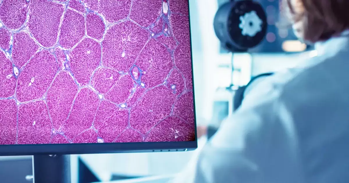 FDA批准首款AI工具AIM-NASH辅助脂肪肝临床试验评估