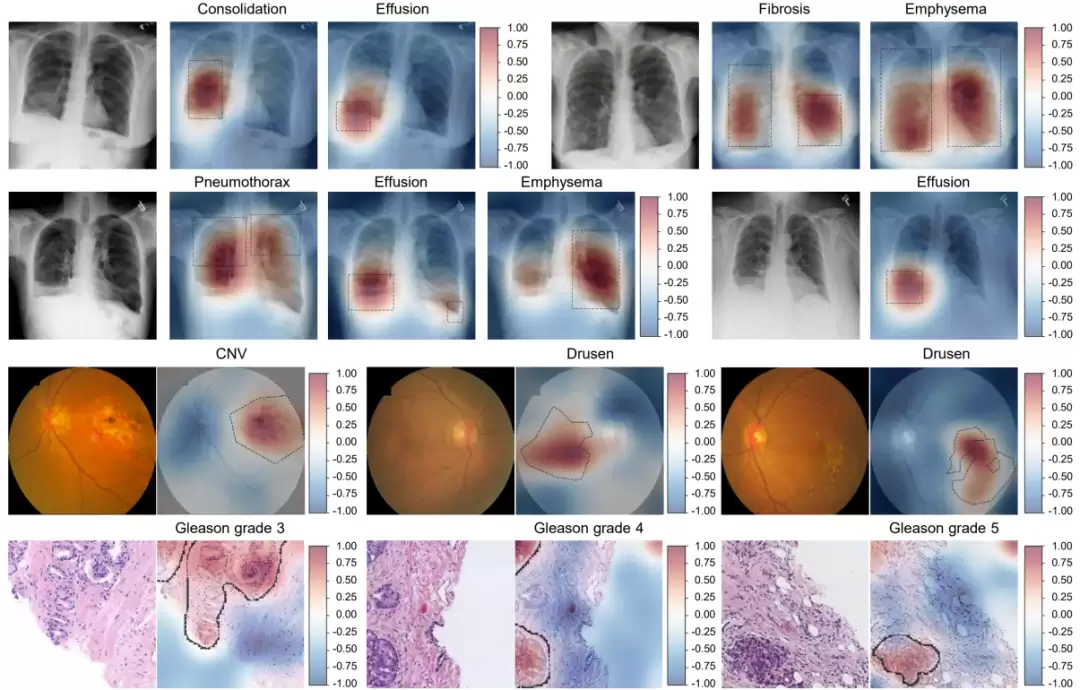 让 AI 自己找病灶、不用医生提前标注，我国科学家新突破