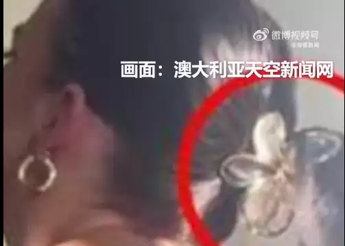 澳大利亚女子驾车遭追尾 头上鲨鱼发夹断裂致脑震荡