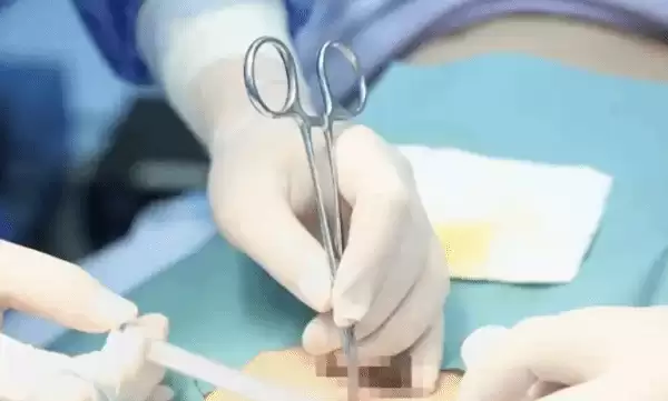 湖北男子20年酗酒难戒，新型戒酒芯片植入术显效