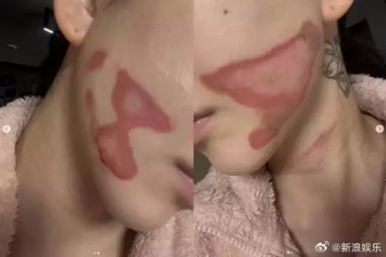 烧得太惨烈!韩国女星做医美竟然导致面度烧伤