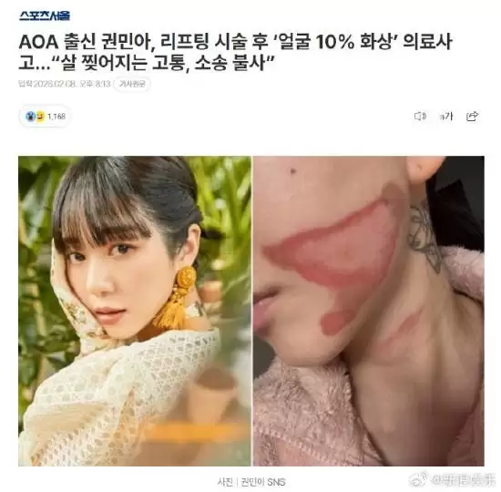 烧得太惨烈!韩国女星做医美竟然导致面度烧伤